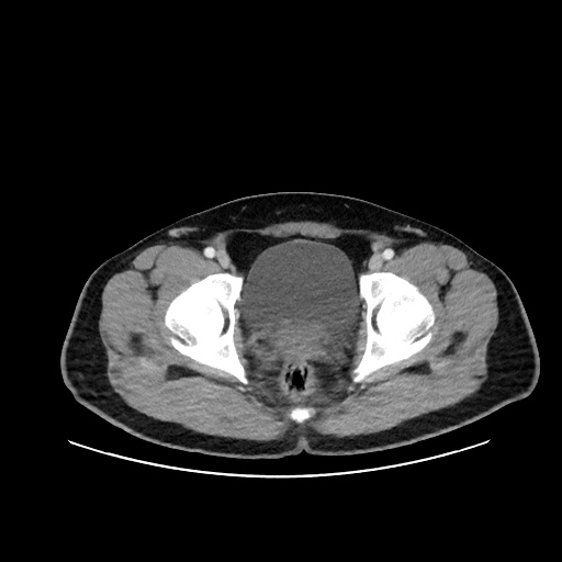 Acute appendicitis and COVID 19 pneumonia (Radiopaedia 76604-88380 Axial C+ portal venous phase 80).jpg
