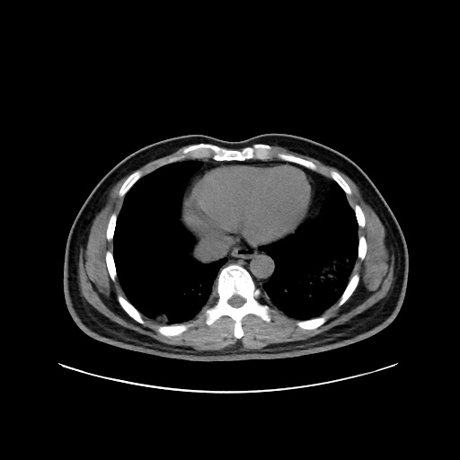 File:Acute appendicitis and COVID 19 pneumonia (Radiopaedia 76604-88380 Axial non-contrast 40).jpg