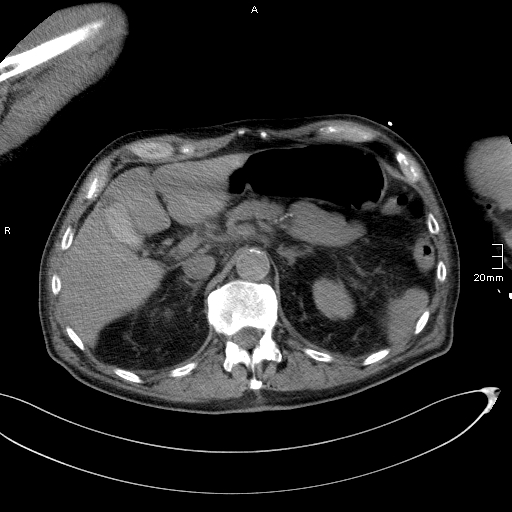 Acute aspiration pneumonitis (Radiopaedia 55642-62166 Axial liver window 63).jpg