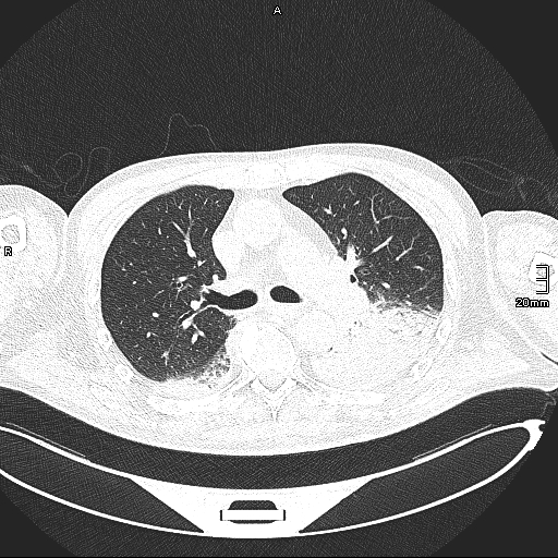 Acute aspiration pneumonitis (Radiopaedia 55642-62166 Axial lung window 66).jpg