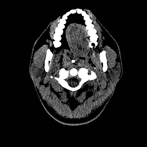 File:Acute basilar artery occlusion (Radiopaedia 43582-46985 Axial non-contrast 12).jpg