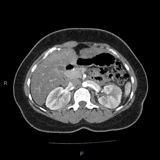Acute bilateral pyelonephritis (Radiopaedia 37146-38881 Axial C+ arterial phase 68).jpg