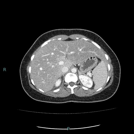 Acute bilateral pyelonephritis (Radiopaedia 37146-38881 Axial C+ portal venous phase 25).jpg
