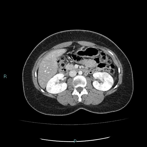 Acute bilateral pyelonephritis (Radiopaedia 37146-38881 Axial C+ portal venous phase 45).jpg