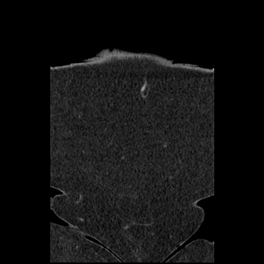 Acute cholecystitis and ureteric colic (Radiopaedia 42330-45444 Coronal prone 13).jpg