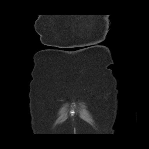 Acute cholecystitis with tensile fundus sign (Radiopaedia 71394-81723 Coronal non-contrast 120).jpg