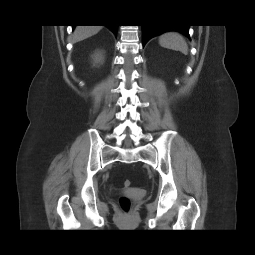 File:Acute cholecystitis with tensile fundus sign (Radiopaedia 71394-81723 Coronal non-contrast 89).jpg