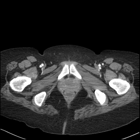 Acute colonic hemorrhage in ulcerative colitis (Radiopaedia 77415-89538 Axial C+ arterial phase 139).jpg