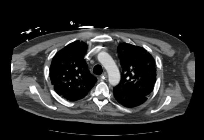 Acute cor pulmonale (ultrasound) (Radiopaedia 83508-98818 Axial C+ CTPA 19).jpg