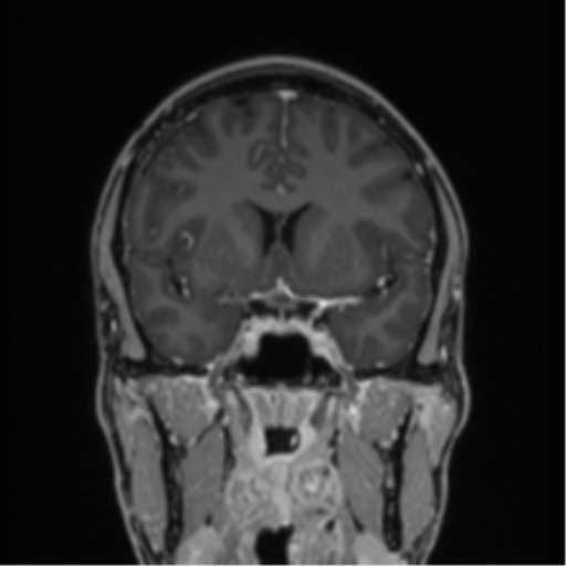 File:Acute disseminated encephalomyelitis (ADEM) (Radiopaedia 65319-74349 Coronal T1 C+ 33).png