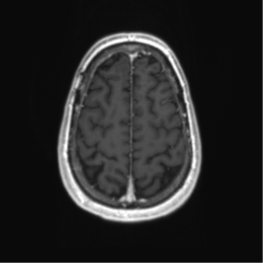Acute disseminated encephalomyelitis (ADEM) (Radiopaedia 65319-74350 Axial T1 C+ 54).png