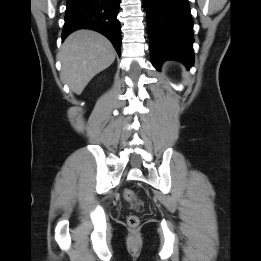 Acute diverticulitis with localized perforation (Radiopaedia 41296-44113 Coronal C+ portal venous phase 48).jpg