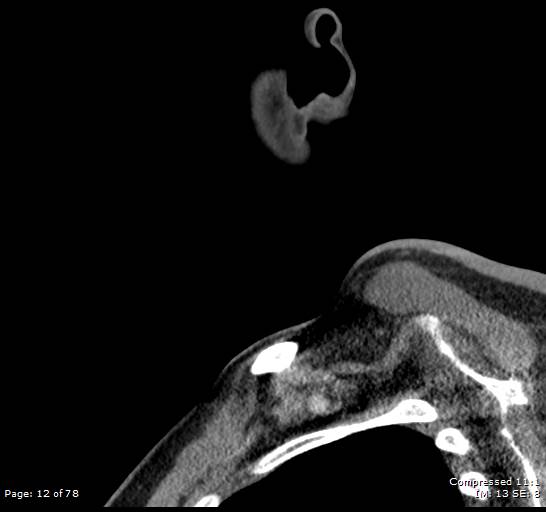Acute epiglottitis (Radiopaedia 54375-60590 Sagittal C+ arterial phase 12).jpg