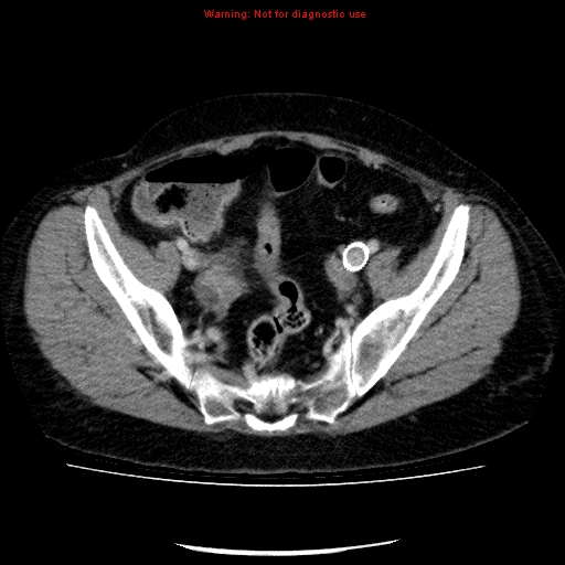 Acute gangrenous cholecystitis (Radiopaedia 10123-10661 Axial C+ portal venous phase 84).jpg