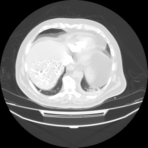 File:Acute heart failure (CT) (Radiopaedia 79835-93075 Axial lung window 40).png