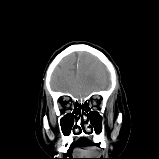 Acute hemorrhagic stroke (Radiopaedia 17507-17223 Coronal non-contrast 10).jpg