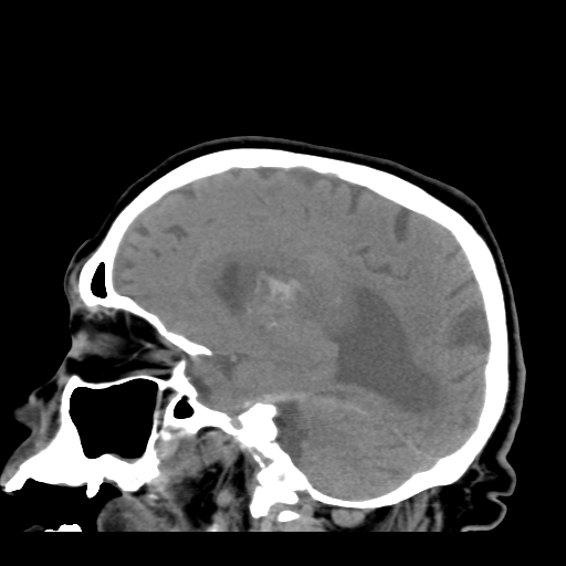 File:Acute hemorrhagic stroke (Radiopaedia 17507-17223 Sagittal non-contrast 29).jpg