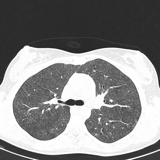 File:Acute hypersensitivity pneumonitis (Radiopaedia 85293-100870 Axial lung window 42).jpg