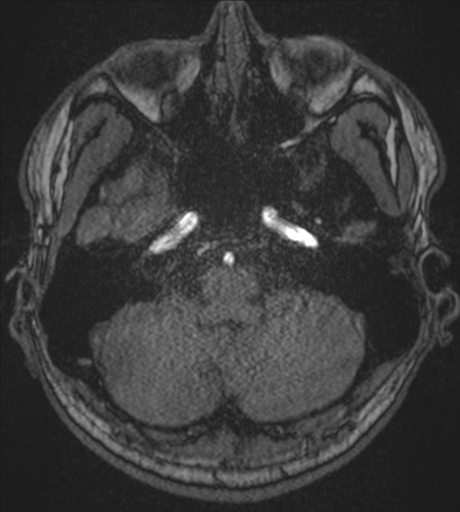 Acute left middle cerebral artery territory infarct with clot retrieval (Radiopaedia 47732-52433 Axial MRA 12).png