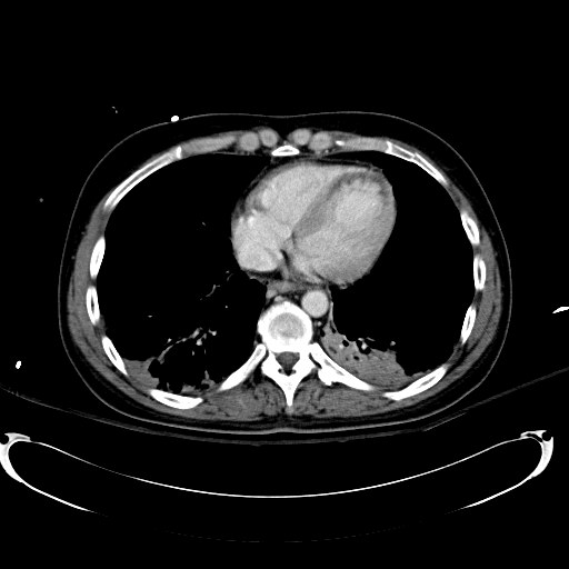 File:Acute myocardial infarction in CT (Radiopaedia 39947-42415 Axial C+ portal venous phase 6).jpg