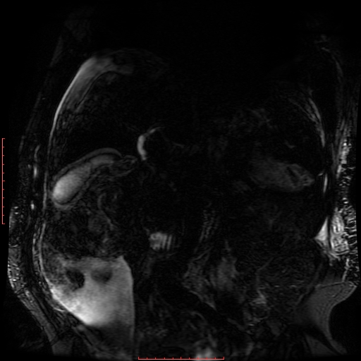 Acute necrotizing pancreatitis (Radiopaedia 28194-28448 Coronal MRCP 41).jpg