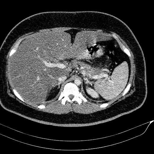 Acute on chronic pancreatitis (Radiopaedia 80902-94423 Axial C+ portal venous phase 43).jpg