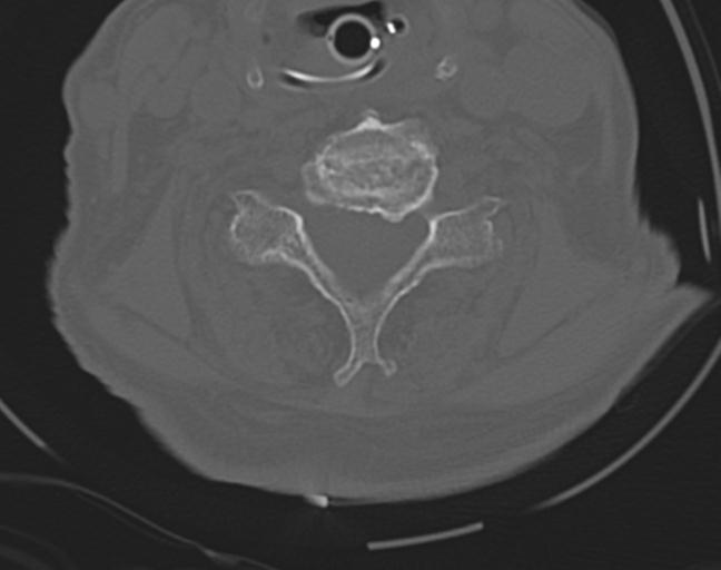 Acute on chronic subdural hematoma and thoracic vertebral injury in a multitrauma patient (Radiopaedia 31698-32619 Axial bone window 38).jpg