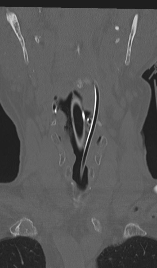 Acute on chronic subdural hematoma and thoracic vertebral injury in a multitrauma patient (Radiopaedia 31698-32619 Coronal bone window 5).jpg