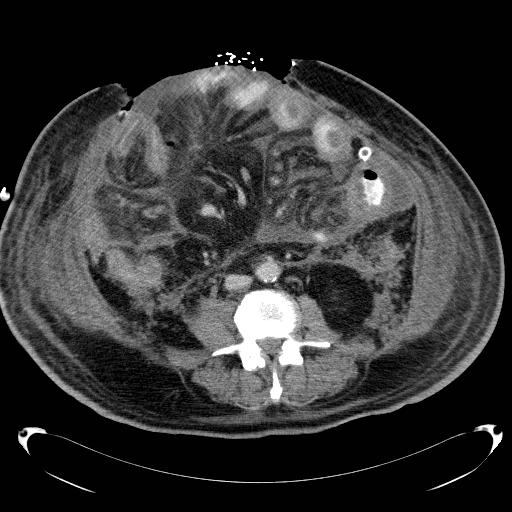 Acute pancreatic necrosis (Radiopaedia 13560-18503 Axial C+ portal venous phase 46).jpg