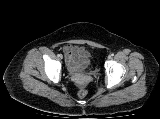 File:Acute pancreatitis (Radiopaedia 69236-79012 Axial C+ portal venous phase 83).jpg