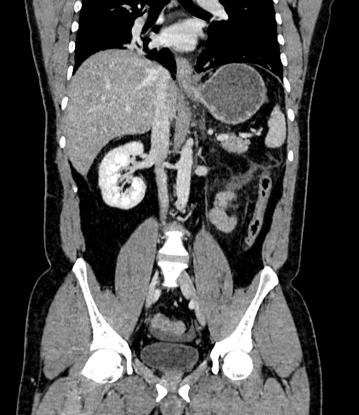 File:Acute pancreatitis (Radiopaedia 87428-103757 Coronal C+ portal venous phase 53).jpg