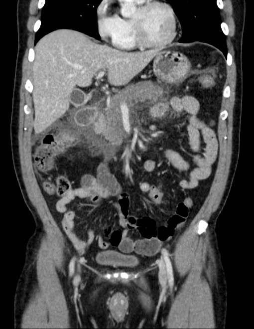 Acute pancreatitis - Balthazar E (Radiopaedia 23080-23110 Coronal C+ portal venous phase 29).jpg