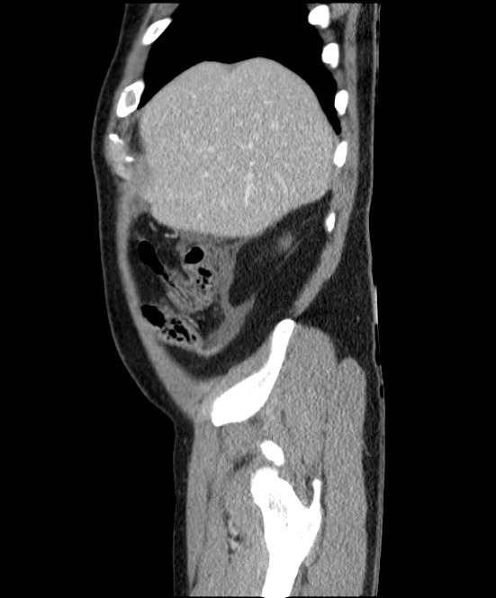Acute pancreatitis - Balthazar E (Radiopaedia 23080-23110 Sagittal C+ portal venous phase 12).jpg