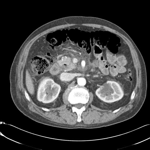 Acute pancreatitis and walled-off necrosis (Radiopaedia 29888-30403 Coronal C+ portal venous phase 1).jpg