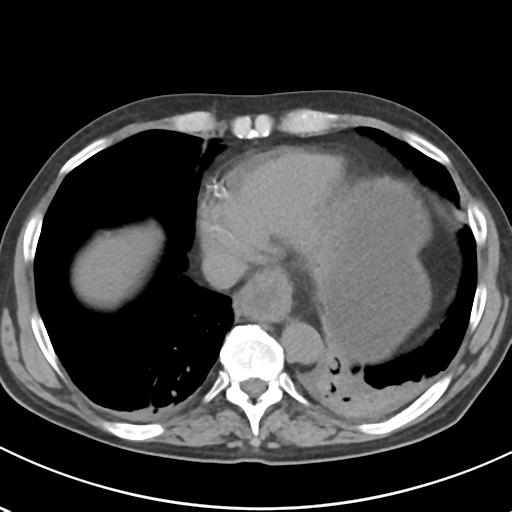 File:Acute pancreatitis and walled-off necrosis (Radiopaedia 29888-30404 Axial non-contrast 5).jpg