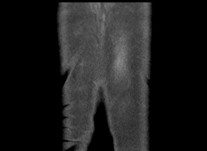 Acute pancreatitis and walled-off necrosis (Radiopaedia 29888-30404 Coronal C+ portal venous phase 51).jpg