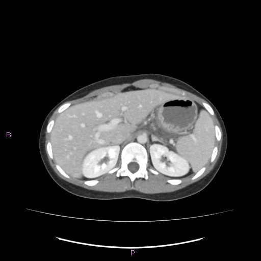 Acute pancreatitis secondary to stone at minor papilla and pancreatic divisum (Radiopaedia 76570-88333 Axial C+ portal venous phase 20).jpg