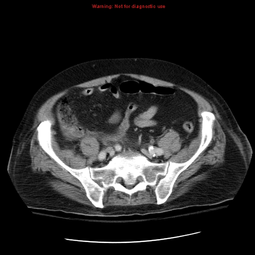 File:Acute pancreatitis with incidental pancreatic lipoma (Radiopaedia 10190-10730 Axial C+ portal venous phase 58).jpg