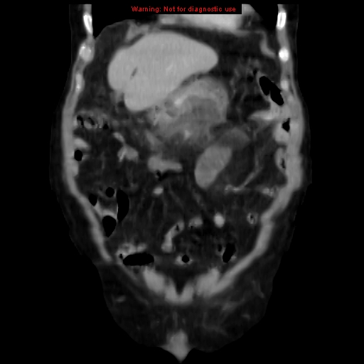Acute pancreatitis with incidental pancreatic lipoma (Radiopaedia 10190-10730 Coronal C+ portal venous phase 16).jpg