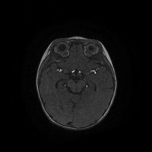 Acute phase of hemiconvulsion-hemiplegia epilepsy syndrome (Radiopaedia 29309-29745 Axial TOF angiography 75).jpg