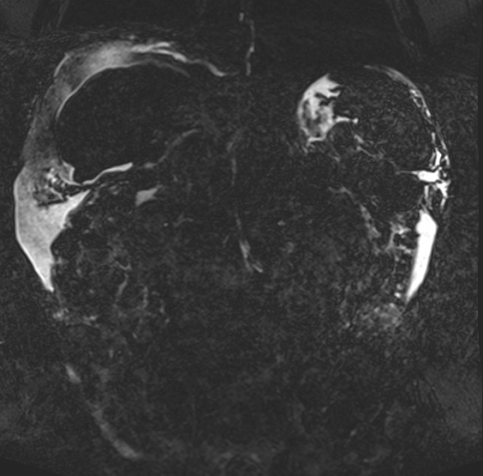 Acute portal vein thrombosis (Radiopaedia 73198-83925 Coronal Heavily T2 thin cuts 59).jpg