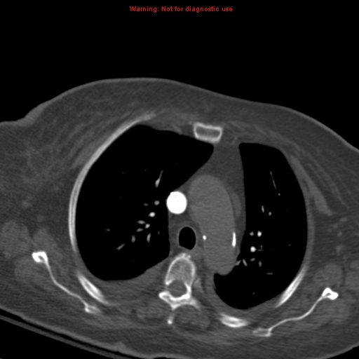 Acute pulmonary embolism (Radiopaedia 13286-13289 Axial C+ CTPA 23).jpg