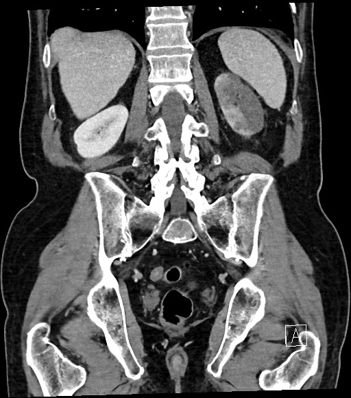 Acute renal infarction (Radiopaedia 59375-66736 Coronal C+ portal venous phase 46).jpg