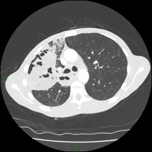 Acute right lung abscess (Radiopaedia 34806-36258 Axial lung window 68).jpg