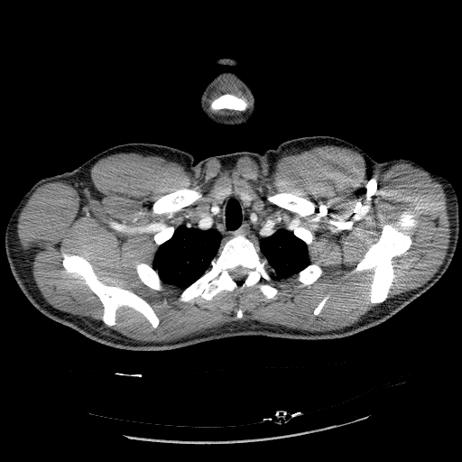 Acute segmental pulmonary emboli and pulmonary infarction (Radiopaedia 62264-70444 Axial C+ CTPA 16).jpg