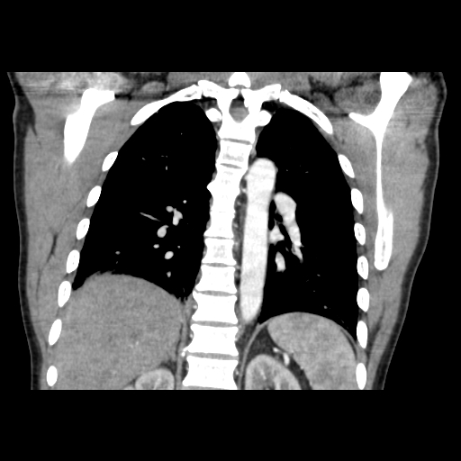 Acute segmental pulmonary emboli and pulmonary infarction (Radiopaedia 62264-70444 Coronal C+ CTPA 37).jpg