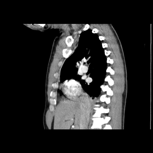 Acute segmental pulmonary emboli and pulmonary infarction (Radiopaedia 62264-70444 Sagittal C+ CTPA 28).jpg
