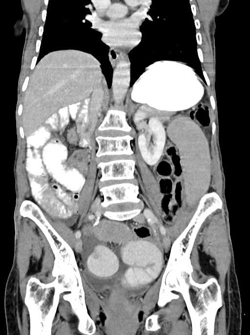 Acute small bowel (ileal) volvulus (Radiopaedia 71740-82139 Coronal C+ portal venous phase 66).jpg
