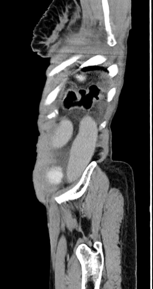 Acute small bowel (ileal) volvulus (Radiopaedia 71740-82139 Sagittal C+ portal venous phase 30).jpg