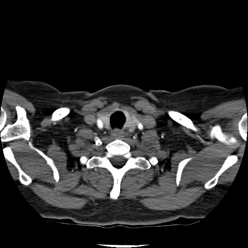 Acute subarachnoid hemorrhage and accessory anterior cerebral artery (Radiopaedia 69231-79009 Axial C+ arterial phase 33).jpg